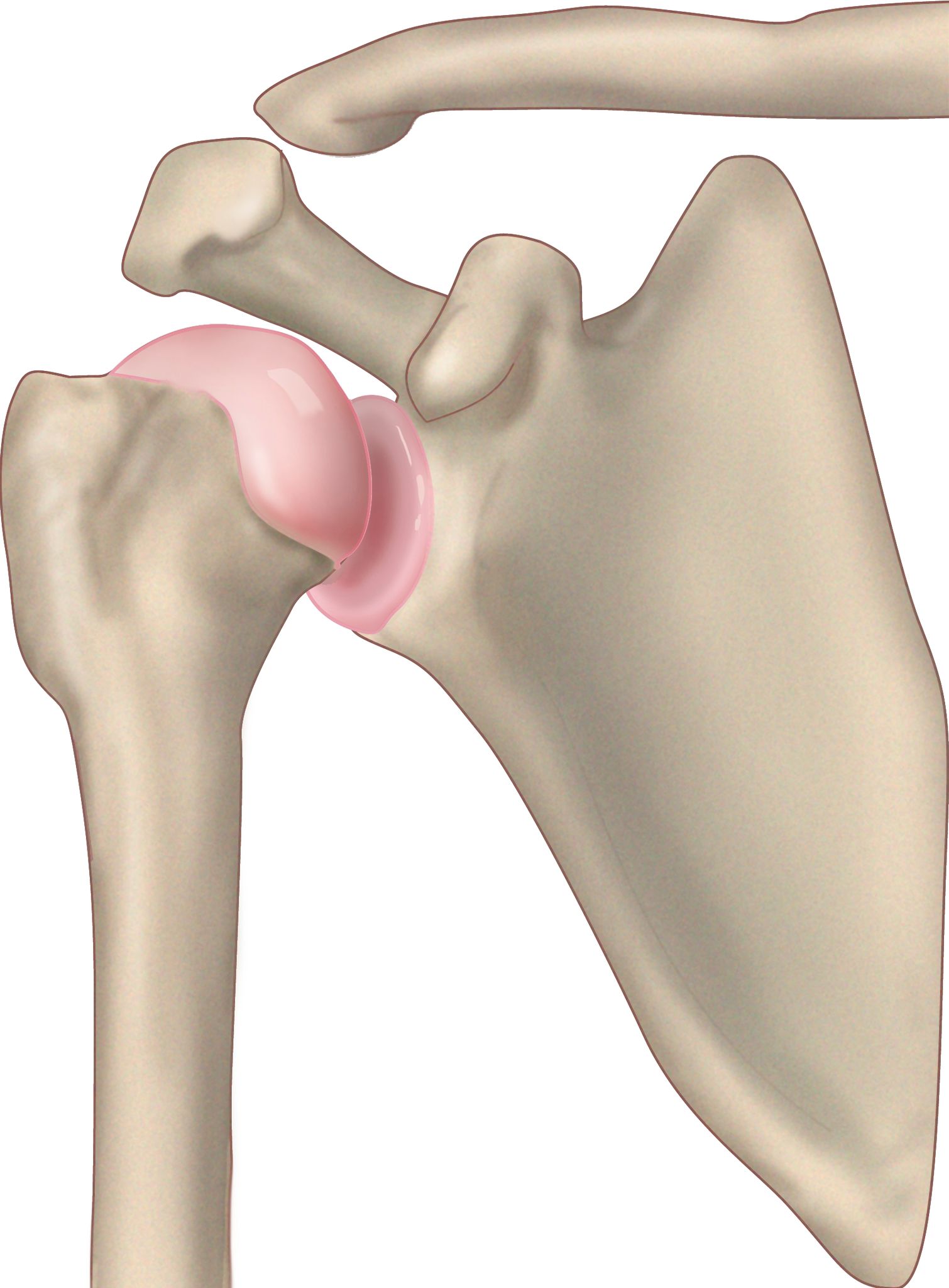 Upala tetive bicepsa